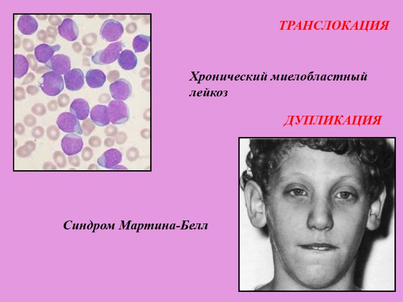 ТРАНСЛОКАЦИЯ Хронический миелобластный лейкоз ДУПЛИКАЦИЯ Синдром Мартина-Белл